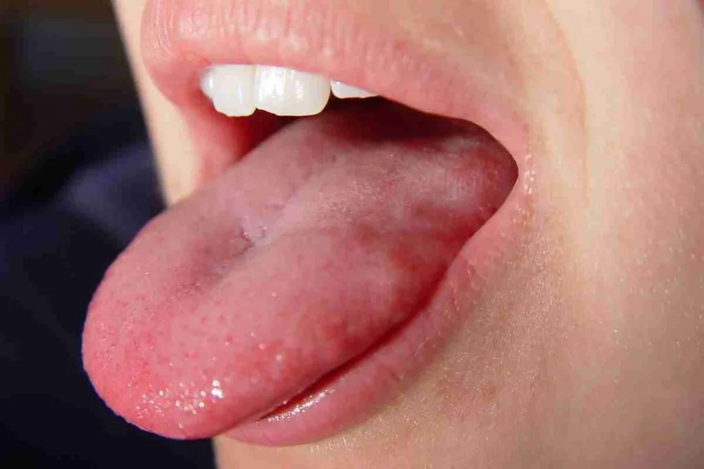 cirurgia-de-cancer-de-lingua